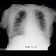 Pulmonary edema, before treatment: X-ray - Plain radiograph