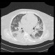 Pumonary edema, pneumonia: CT - Computed tomography