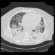 Pumonary edema, pneumonia: CT - Computed tomography