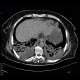 Pumonary edema, pneumonia: CT - Computed tomography