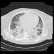 Pumonary edema, pneumonia: CT - Computed tomography