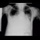 Pulmonary embolism, pulmonary hypertension, cardiomegally, correlation: X-ray - Plain radiograph