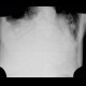 Pulmonary embolism, pulmonary hypertension, cardiomegally, correlation: X-ray - Plain radiograph