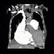 Pulmonary embolism, pulmonary hypertension, cardiomegally, correlation: CT - Computed tomography