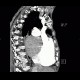 Pulmonary embolism, pulmonary hypertension, cardiomegally, correlation: CT - Computed tomography