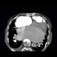 Pulmonary embolism, pulmonary hypertension, cardiomegally, correlation: CT - Computed tomography