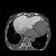 Pulmonary embolism, pulmonary hypertension, cardiomegally, correlation: CT - Computed tomography