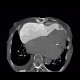 Pulmonary embolism, pulmonary hypertension, cardiomegally, correlation: CT - Computed tomography