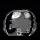 Pulmonary embolism, pulmonary hypertension, cardiomegally, correlation: CT - Computed tomography