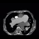 Pulmonary embolism, pulmonary hypertension, cardiomegally, correlation: CT - Computed tomography