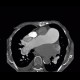Pulmonary embolism, pulmonary hypertension, cardiomegally, correlation: CT - Computed tomography