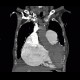 Pulmonary embolism, pulmonary hypertension, cardiomegally, correlation: CT - Computed tomography