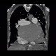 Pulmonary embolism, pulmonary hypertension, cardiomegally, correlation: CT - Computed tomography