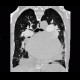 Pulmonary embolism, pulmonary hypertension, cardiomegally, correlation: CT - Computed tomography