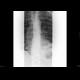 Pulmonary infarction, pulmonary embolism: X-ray - Plain radiograph