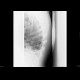 Pulmonary infarction, pulmonary embolism: X-ray - Plain radiograph