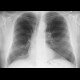 Lung tumour, adjacent to the left hilum: X-ray - Plain radiograph