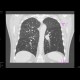 Lung tumour, adjacent to the left hilum: CT - Computed tomography