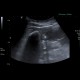 Gallstones, cholesterol, floating: US - Ultrasound