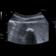 Gallstones, cholesterol, floating: US - Ultrasound