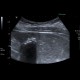 Gallstones, cholesterol, floating: US - Ultrasound