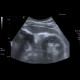 Gallstones, cholesterol, floating: US - Ultrasound