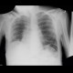 Pneumatosis of lienal flexure, constipation, skyballa: X-ray - Plain radiograph