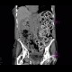 Pneumatosis of lienal flexure, constipation, skyballa: CT - Computed tomography