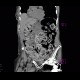 Pneumatosis of lienal flexure, constipation, skyballa: CT - Computed tomography