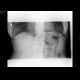 Pneumatosis of small bowel, meteorism: X-ray - Plain radiograph