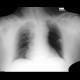 Pneumonectomy: X-ray - Plain radiograph