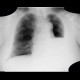Pneumonectomy, follow-up: X-ray - Plain radiograph