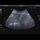 Pneumobilia: US - Ultrasound