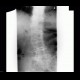 Pneumobilia: X-ray - Plain radiograph