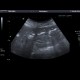 Pneumobilia: US - Ultrasound