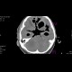 Pneumocephalus, massive: CT - Computed tomography