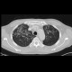 Pneumocystis pneumonia: CT - Computed tomography