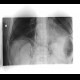 Pneumomediastinum, pneumoretroperitoneum, perforation of sigmoid colon, complication of colonoscopy: X-ray - Plain radiograph