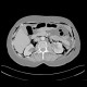 Pneumomediastinum, pneumoretroperitoneum, perforation of sigmoid colon, complication of colonoscopy: CT - Computed tomography