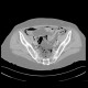 Pneumomediastinum, pneumoretroperitoneum, perforation of sigmoid colon, complication of colonoscopy: CT - Computed tomography