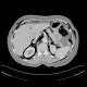 Pneumomediastinum, pneumoretroperitoneum, perforation of sigmoid colon, complication of colonoscopy: CT - Computed tomography