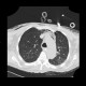 Pneumomediastinum, pneumothorax, PNO, subcutaneous emphysema: CT - Computed tomography