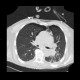 Pneumomediastinum, pneumothorax, PNO, subcutaneous emphysema: CT - Computed tomography