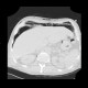 Pneumomediastinum, pneumothorax, PNO, subcutaneous emphysema: CT - Computed tomography