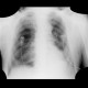 Pneumomediastinum, pneumothorax, PNO, subcutaneous emphysema: X-ray - Plain radiograph