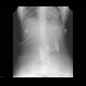 Pneumomediastinum, pneumocolum, subcutaneous emphysema, intermuscular emphysema: X-ray - Plain radiograph
