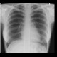 Pneumomediastinum: X-ray - Plain radiograph