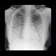 Pneumomediastinum, pneumocolum, subcutaneous emphysema, intermuscular emphysema: X-ray - Plain radiograph