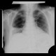 Lobar pneumonia: X-ray - Plain radiograph