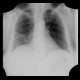Lobar pneumonia, resolution: X-ray - Plain radiograph
